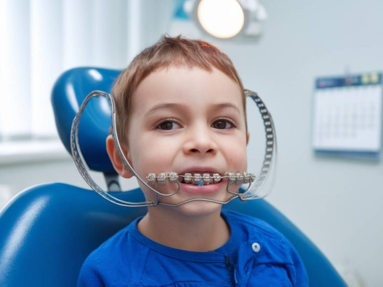 les traitements orthodontiques avancés pour les enfants ayant une mâchoire étroite